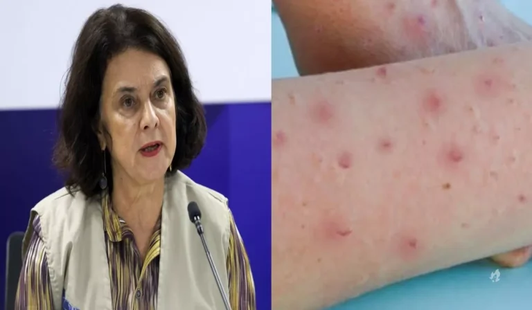 Ministra da Saúde revela que Brasil está no primeiro nível de emergência da mpox