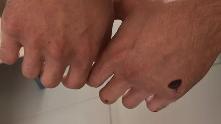 ‘Eu fui capotando, senti impotência mesmo, não dava para fazer nada’, desabafa motociclista que caiu em buraco em Mogi das Cruzes