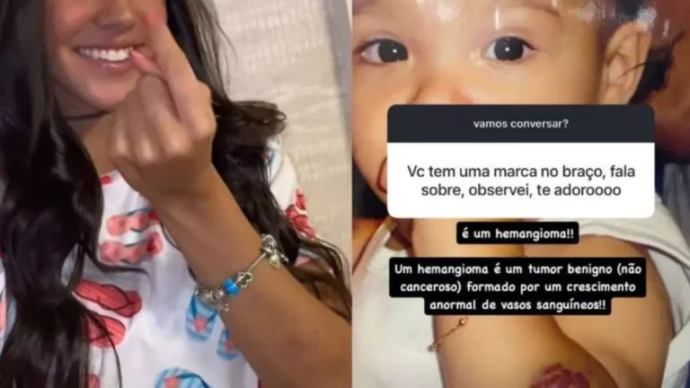 Câncer? Ex-namorada de Benício Huck, Duda Guerra revela origem de marca no braço