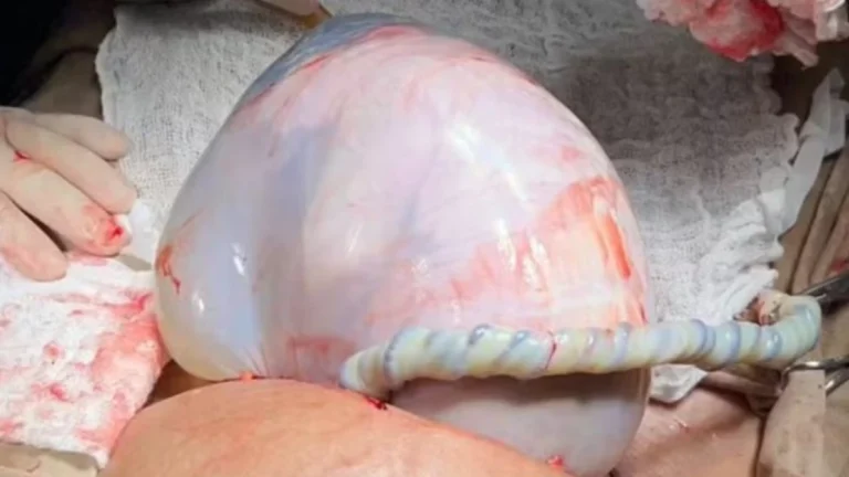 Gêmea nasce em bolsa de pele e médico esclarece fenômeno raro: Acaso