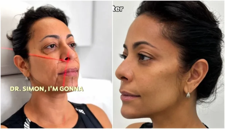 Samantha Schmütz transforma rosto com médico das Kardashians; veja