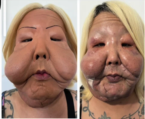 Juju do Pix passa por pequena cirurgia após 1ª retirada de óleo mineral