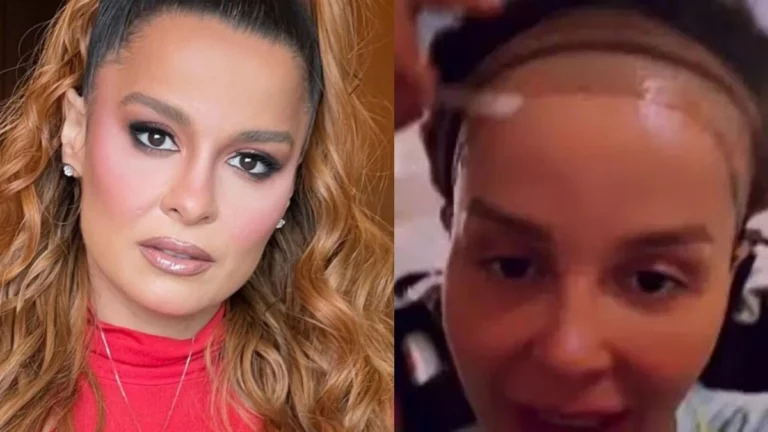 Conheça a doença que não tem cura e que quase deixou Maiara careca: ‘Problema genético’