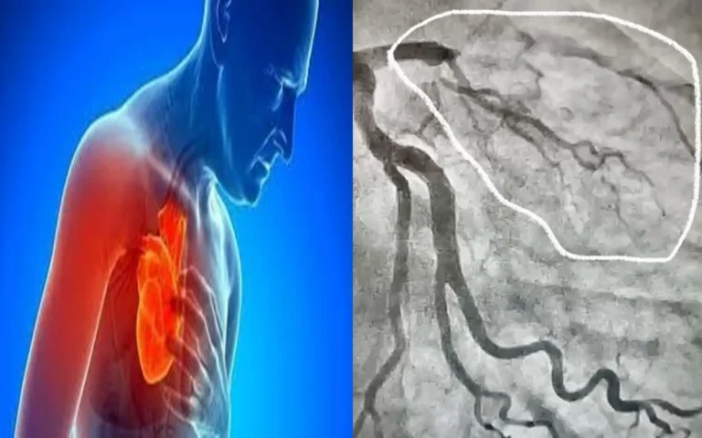 Esses são os sinais que o corpo dá antes de ter um infarto, aponta cardiologista