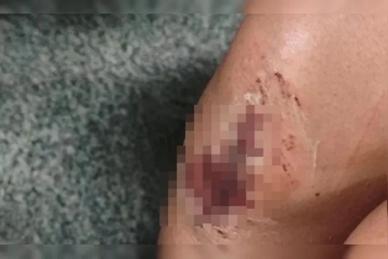 Jovem fica com feridas em carne viva após ser espancada por irmão e ex