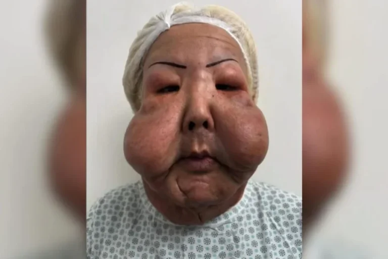 Veja como está Juju do Pix seis meses depois de cirurgia facial