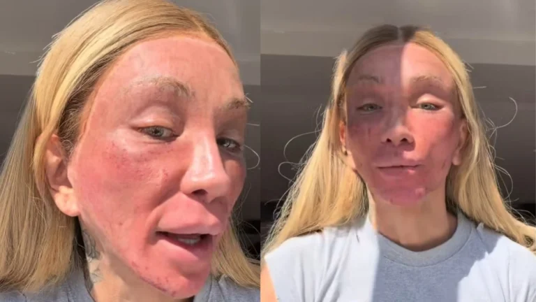 Maya Massafera aparece com rosto alterado por peeling facial e choca web