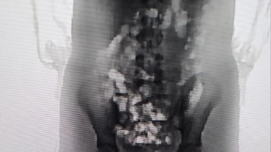 Adolescente tenta entrar em presídio com 32 porções de droga no corpo em SC